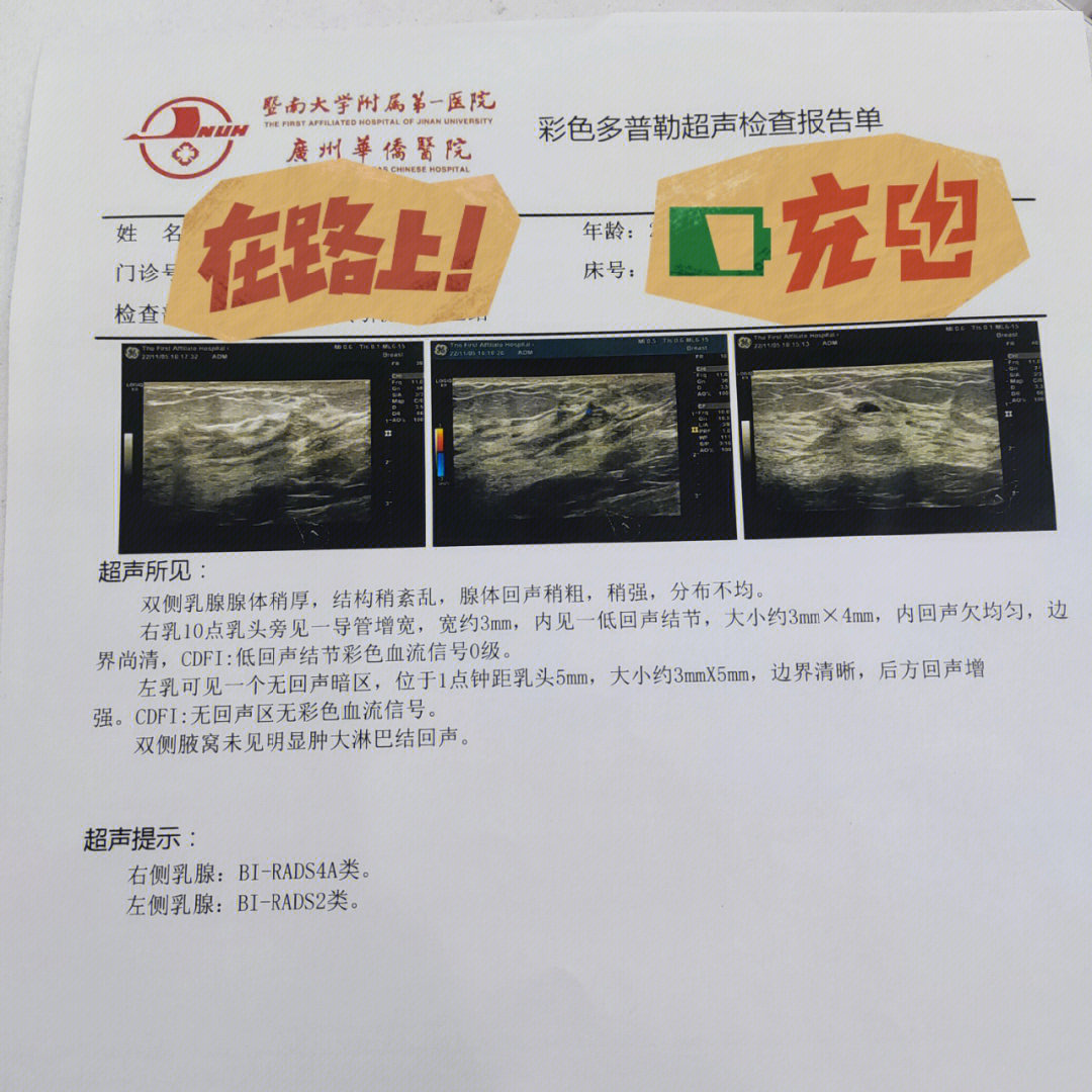 男性乳腺发育超声报告图片