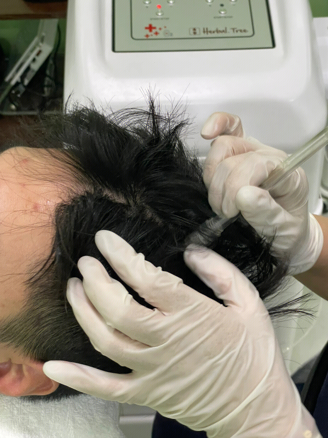给头皮做个spa养发也重要记录植发第三周