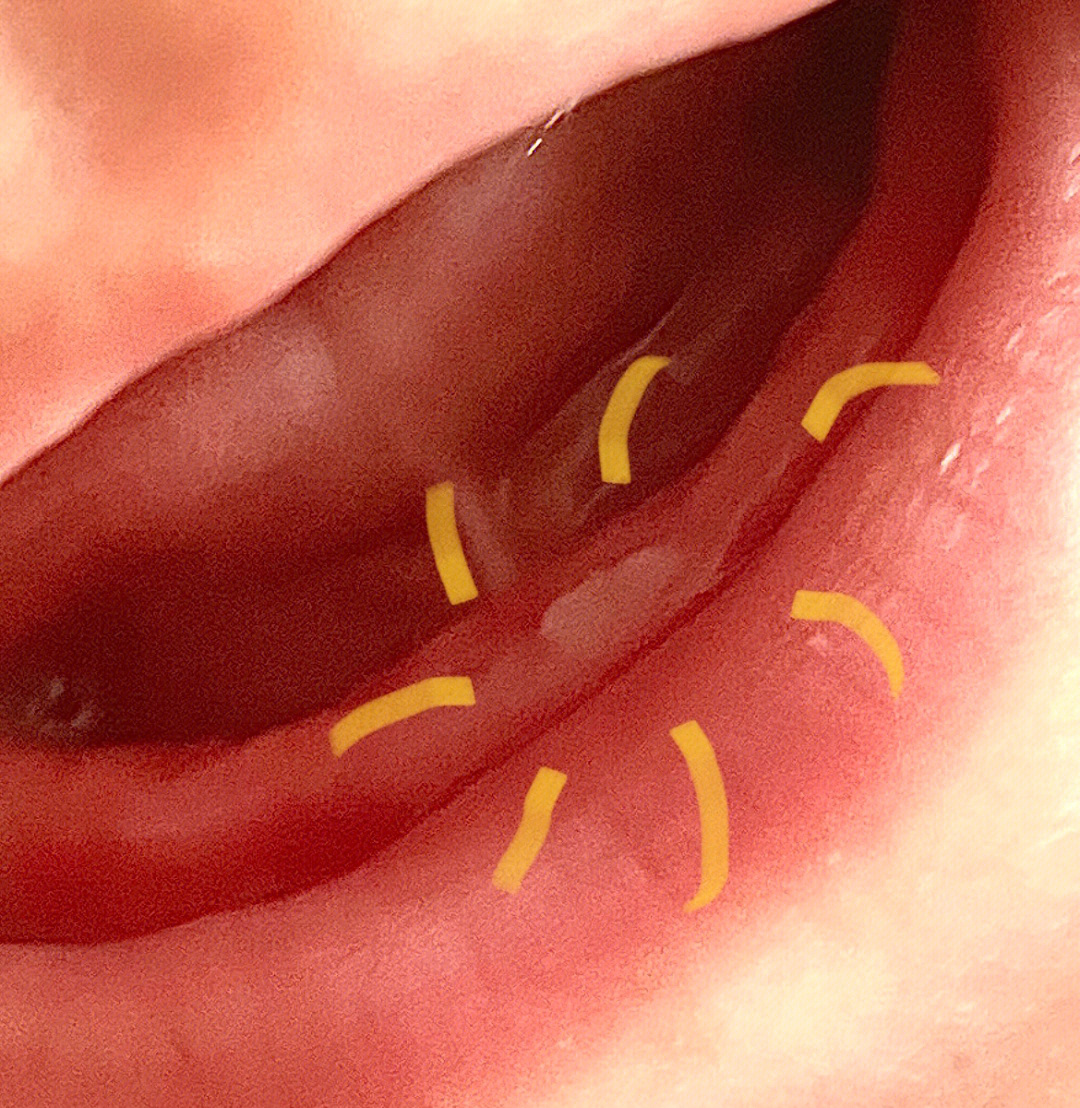婴儿长牙牙龈变化过程图片