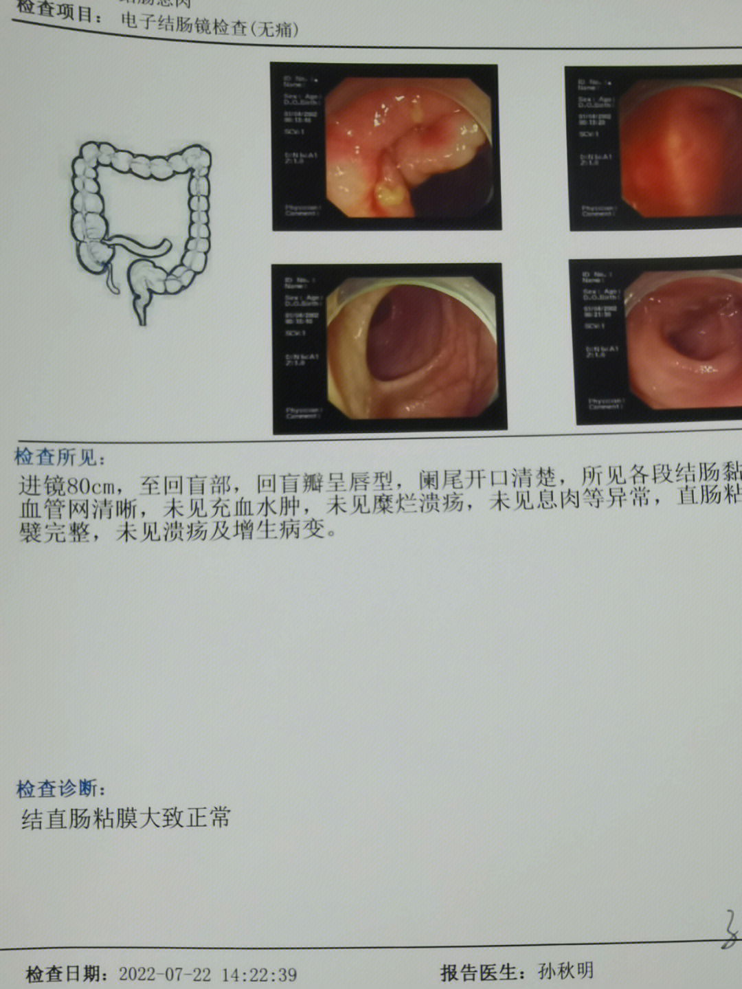 肠镜活检报告图片