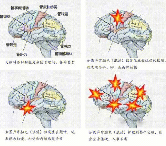 大脑中央前回异常放电⑵复杂部分发作(又称颞叶癫痫)①意识障碍②反复