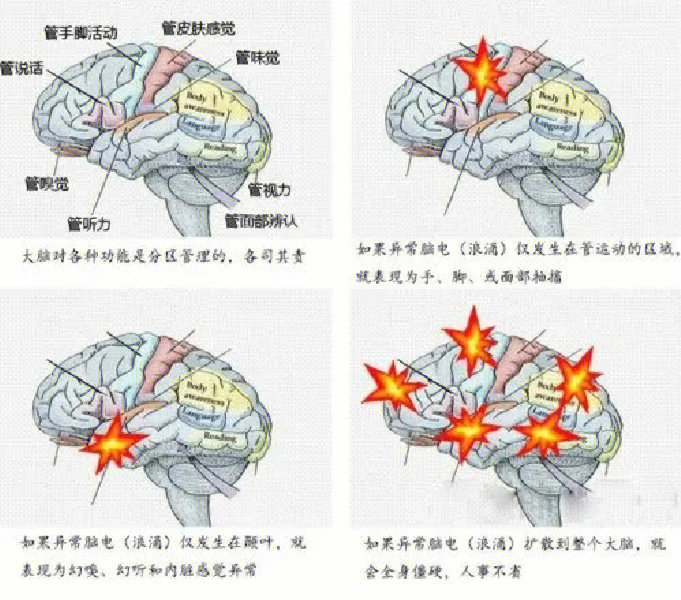 从零开始学神经病学56癫痫2