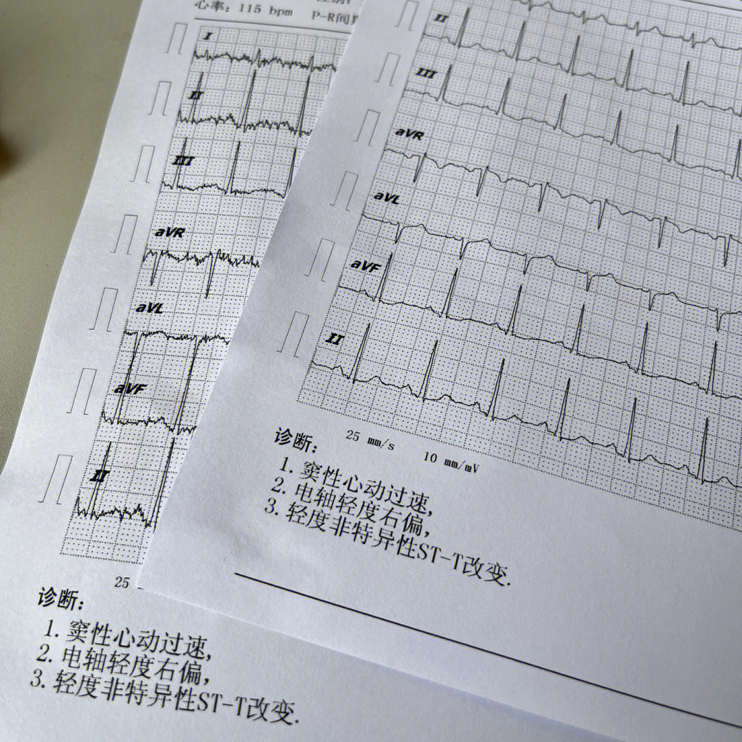 年轻人心率过快可别紧张01