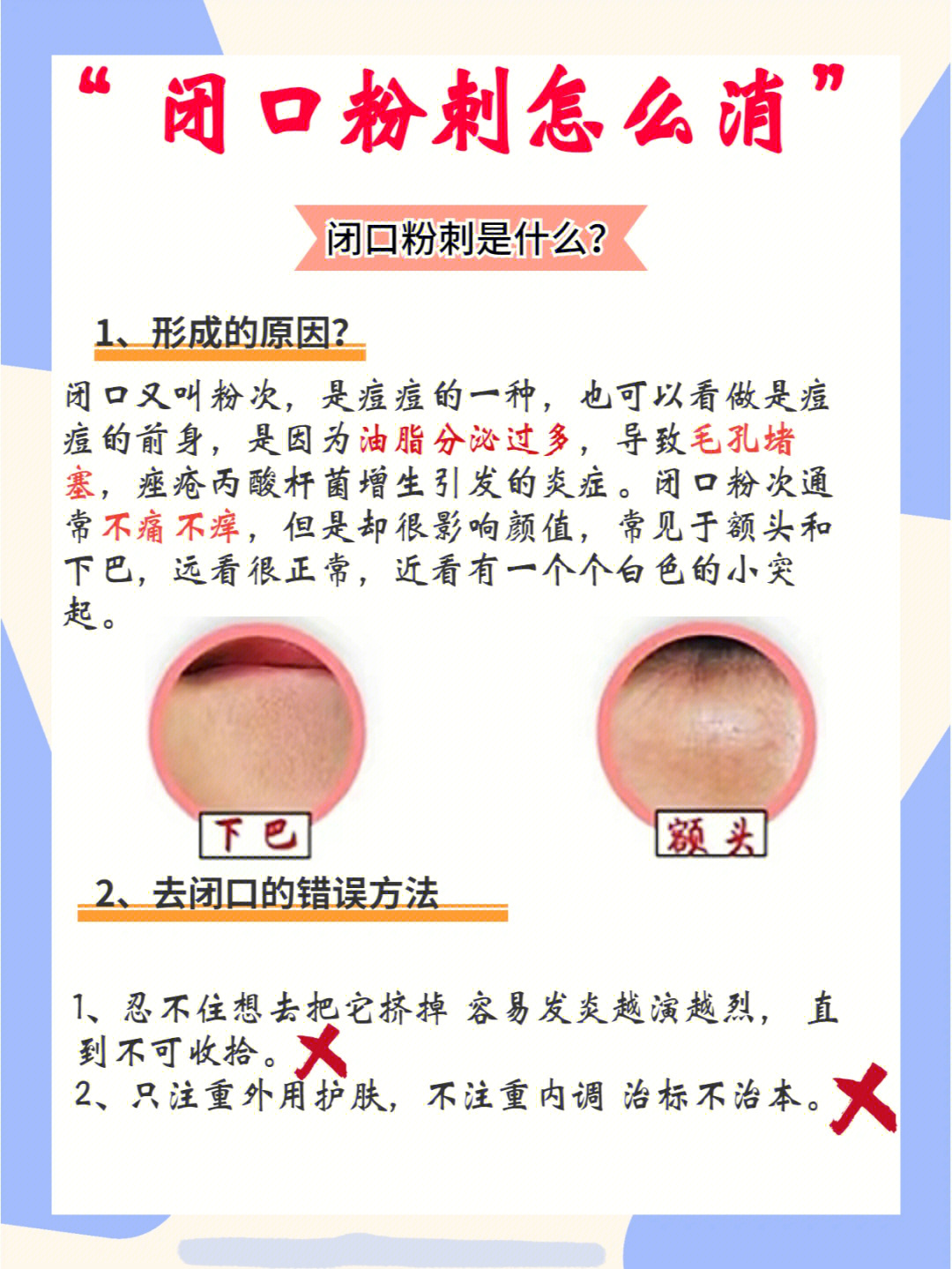 长闭口粉刺的主要原因图片