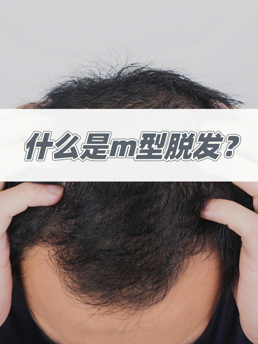 99m型脱发是指男性雄激素性脱发中,脱发特点是发际线两侧前额角的