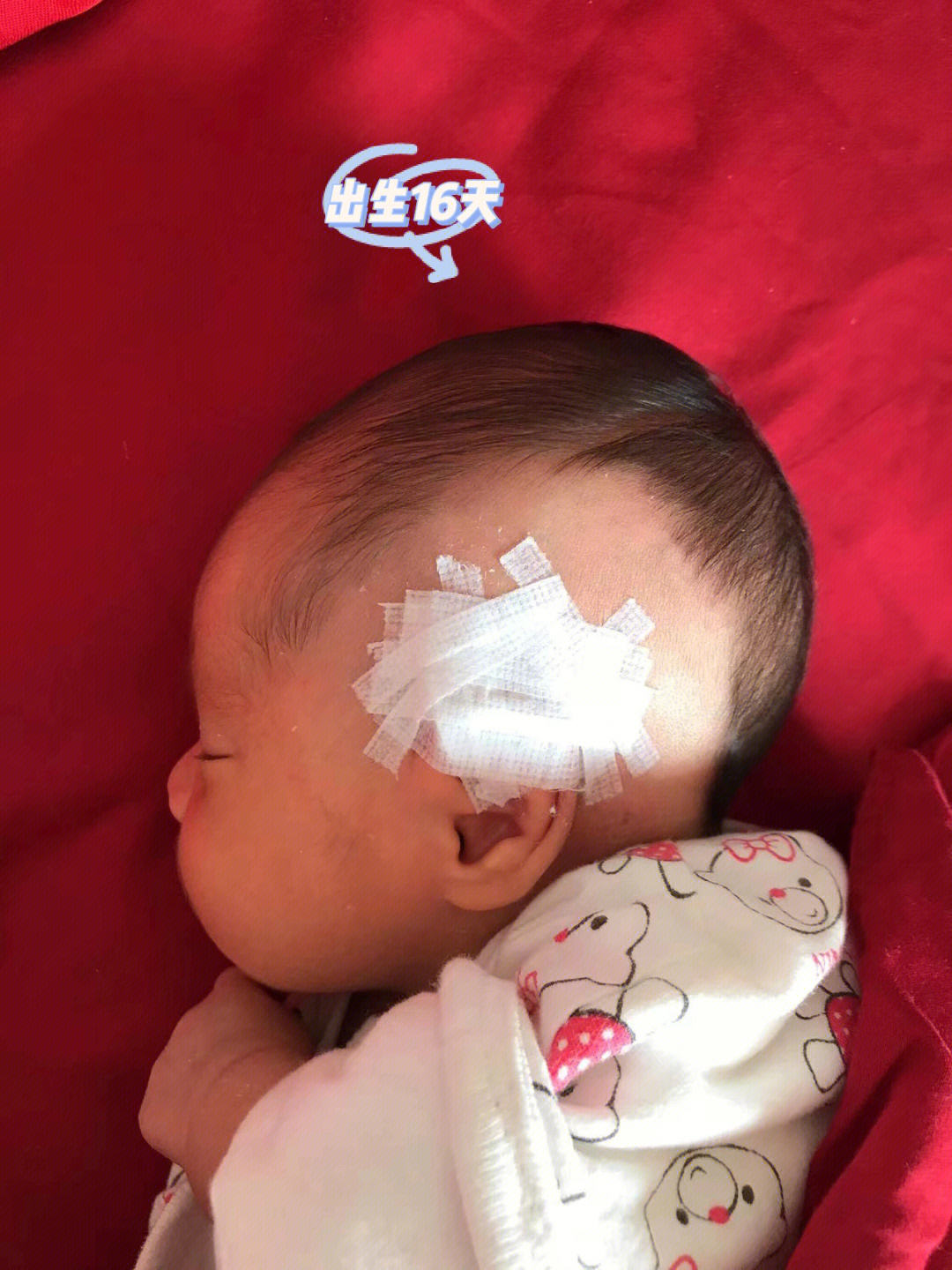 宝宝后脑勺有红色斑块图片