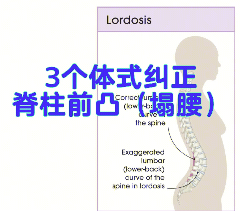 腰椎前凸自我矫正法图图片