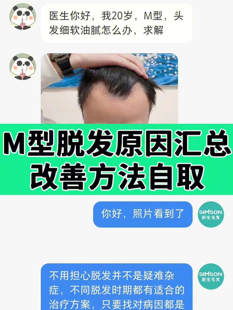 男性m型脱发原因及处理方式汇总篇