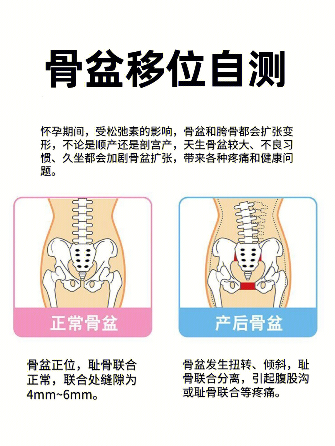 产后骨盆修复有必要吗图片