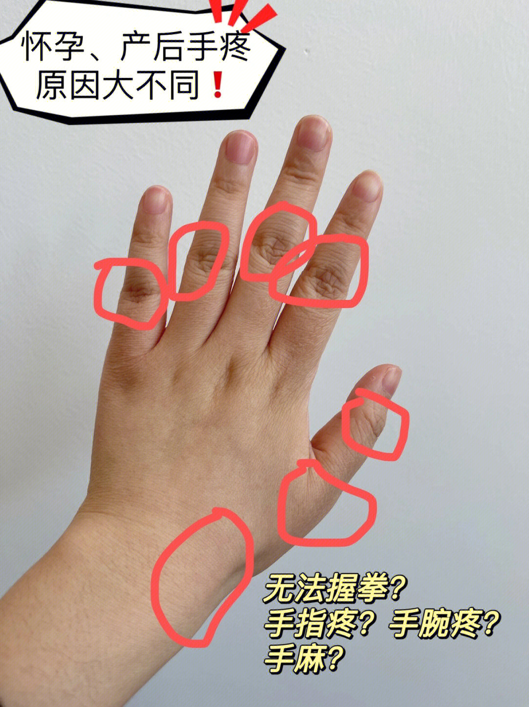 9799主要症状:手腕痛,手指手掌麻木,手指关节痛等