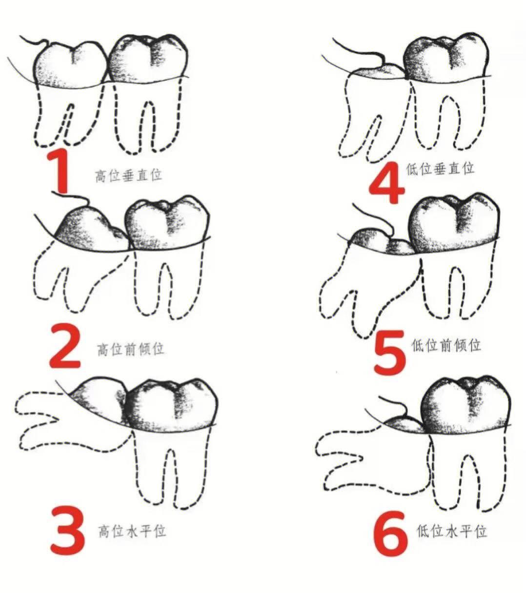 上面智齿正常位置图图片