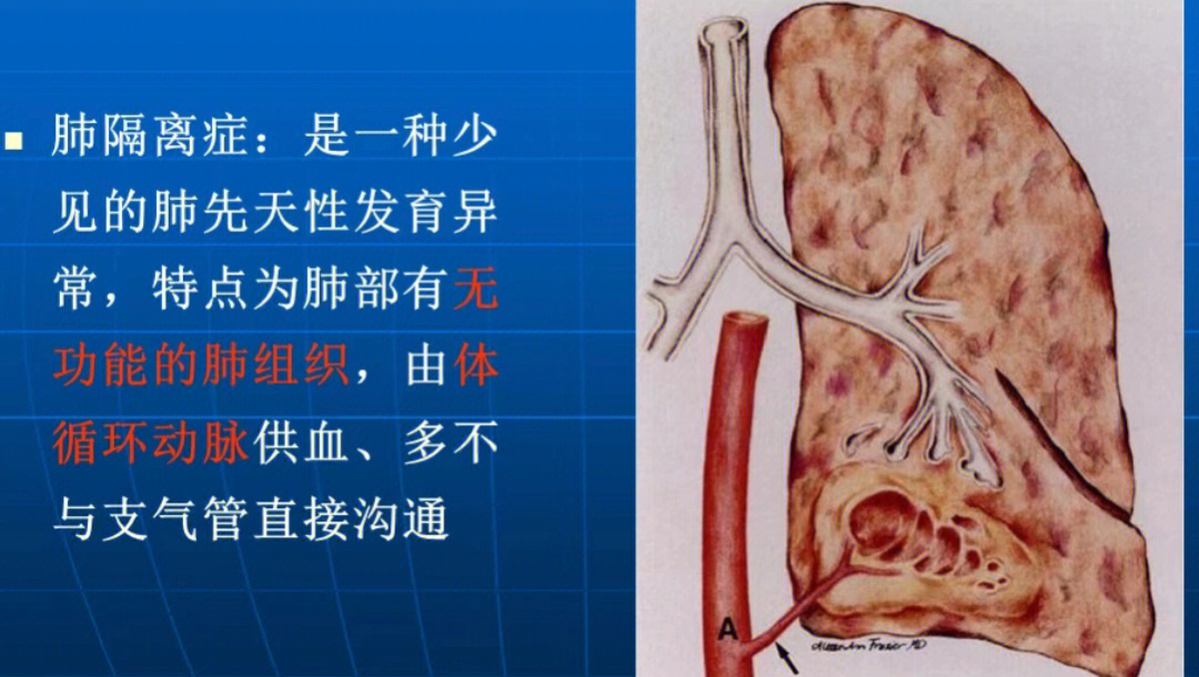 肺隔离征