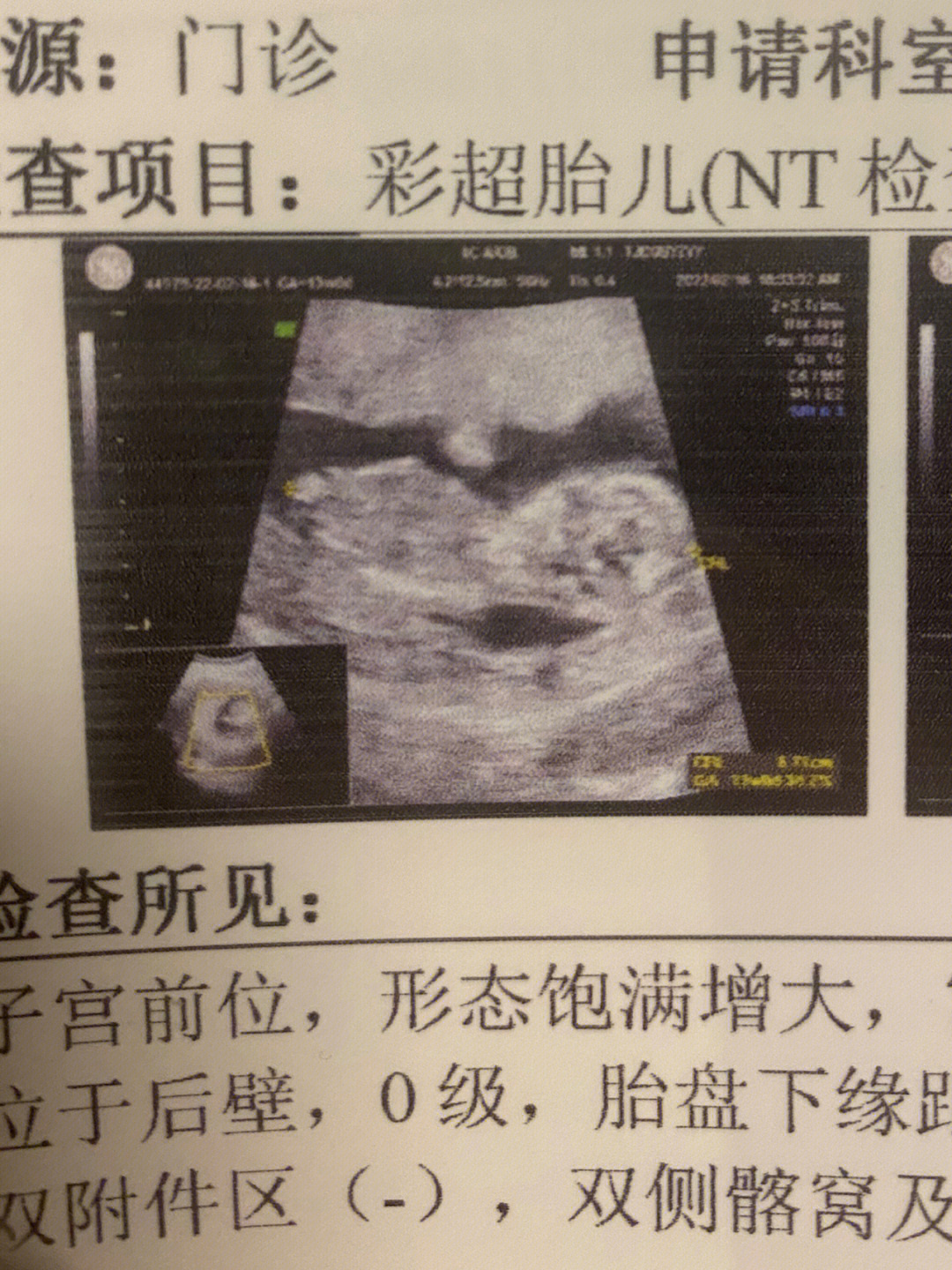 nt看胎儿性别图解图片