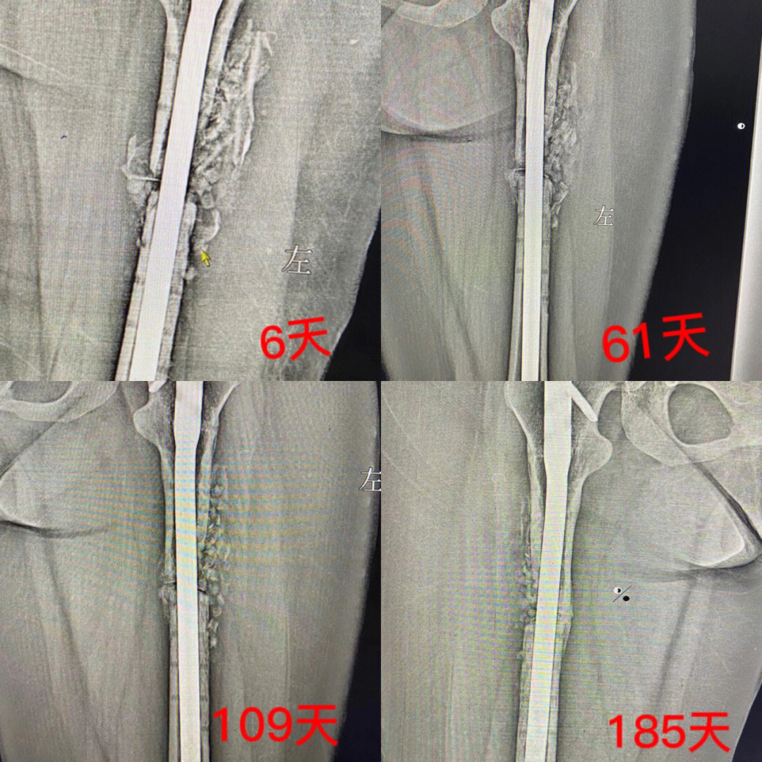 记录骨折术后185天