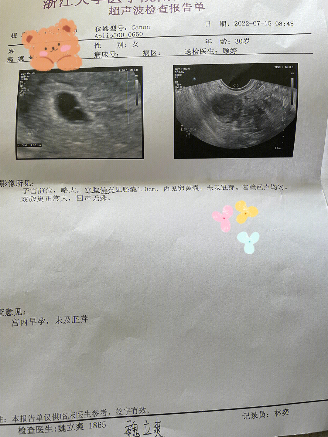 孕囊长宽高示意图图片