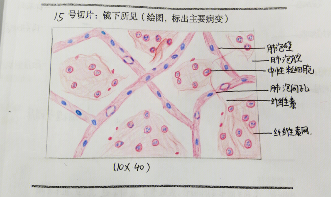 纤维肉瘤红蓝铅笔图图片