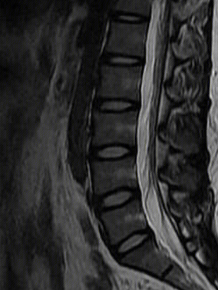 腰椎硬膜囊受压图片