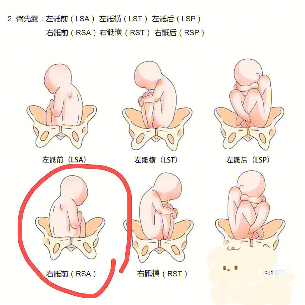 胎儿臀位图片纠正图片