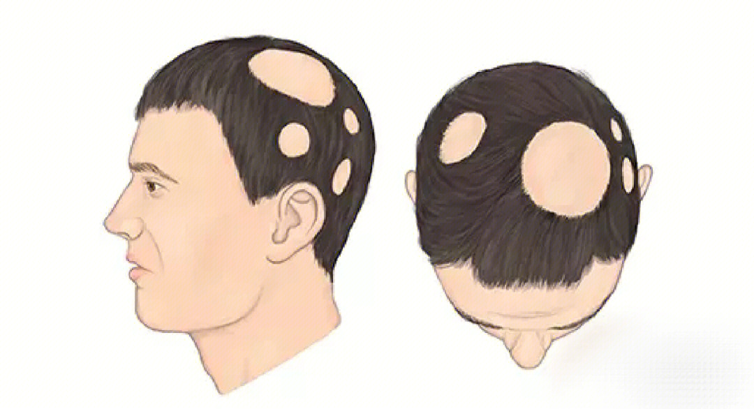斑秃的原因和治疗方法图片