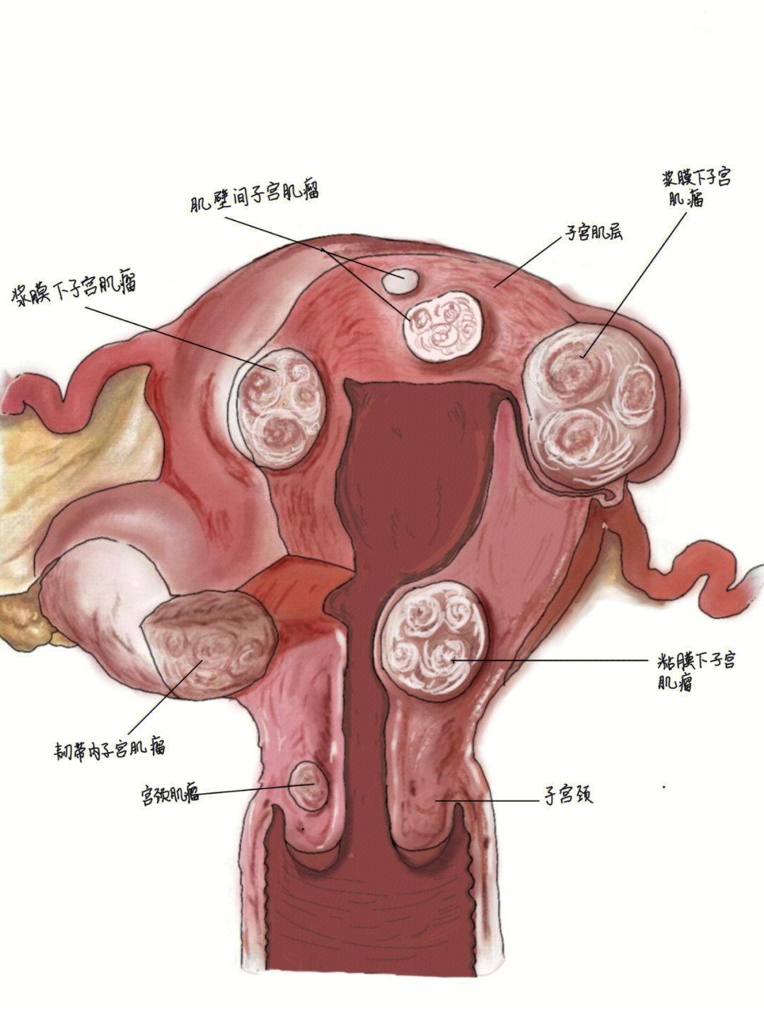 并进行结构标准,展现了子宫肌瘤的大小,质地,位置,及其分类
