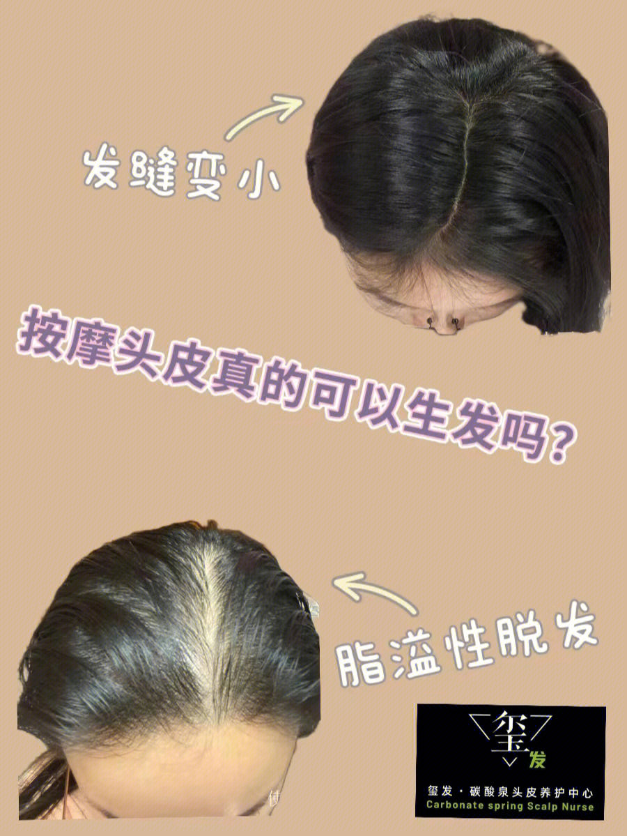 使用正确的方法按摩头皮989969♀15 是可以治脱生发的