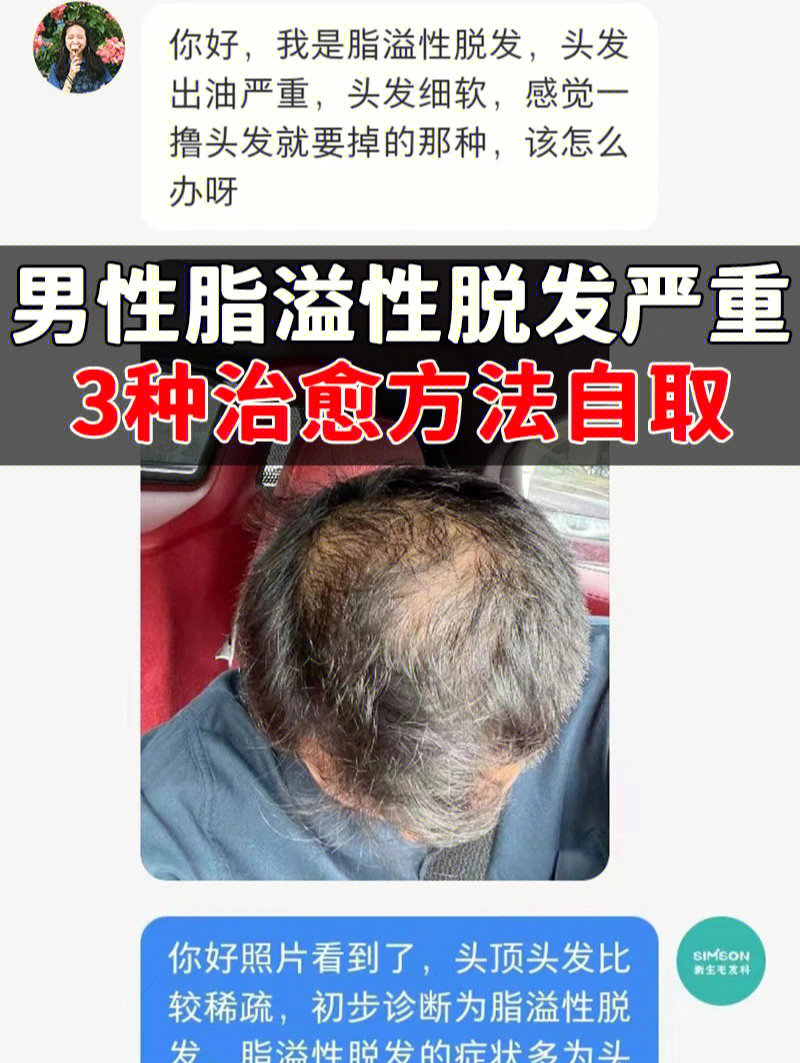 脂溢性脱发能不能治愈?3种恢复方法自取!