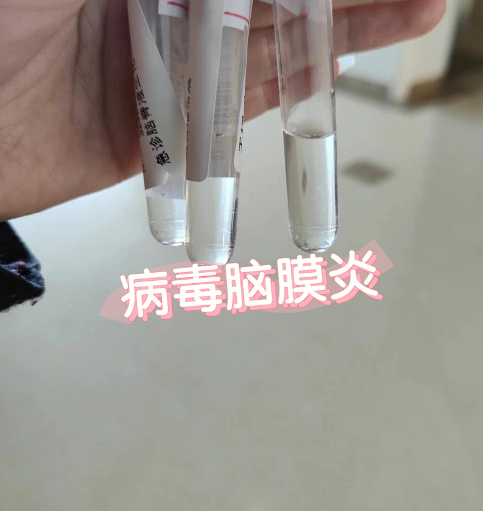 病毒性脑膜炎