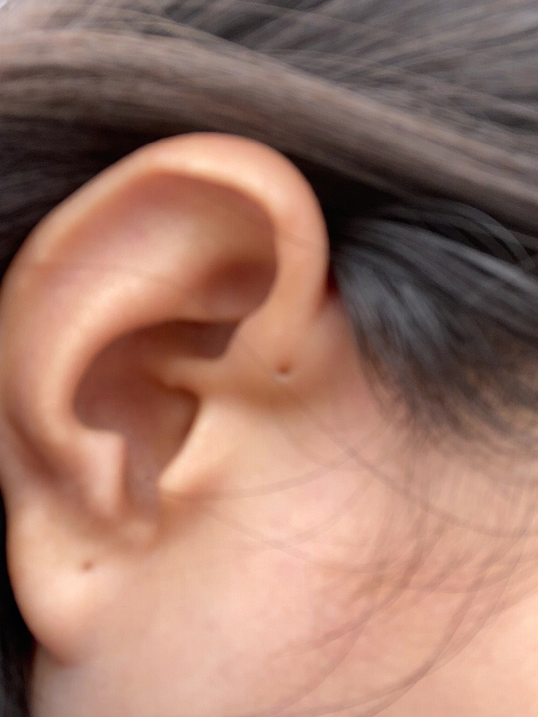 耳前瘘管遗传图谱图片
