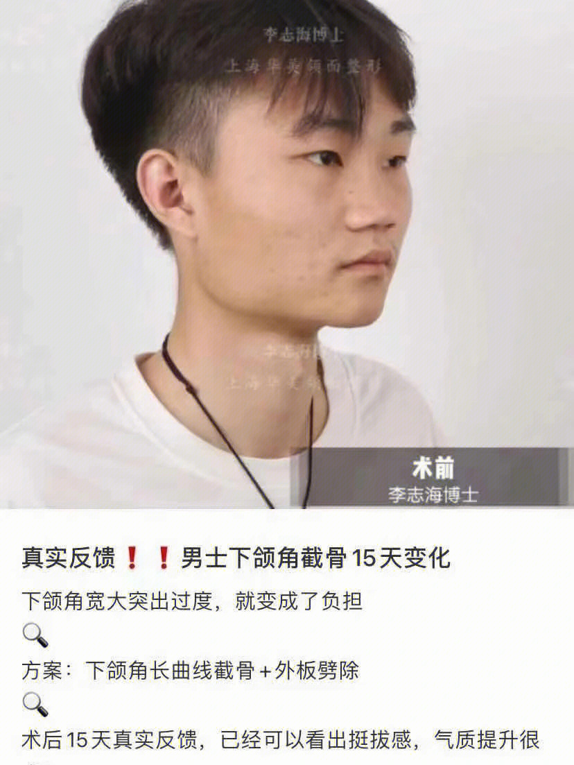 男士下颌角效果对比整个人都柔和了好多呀