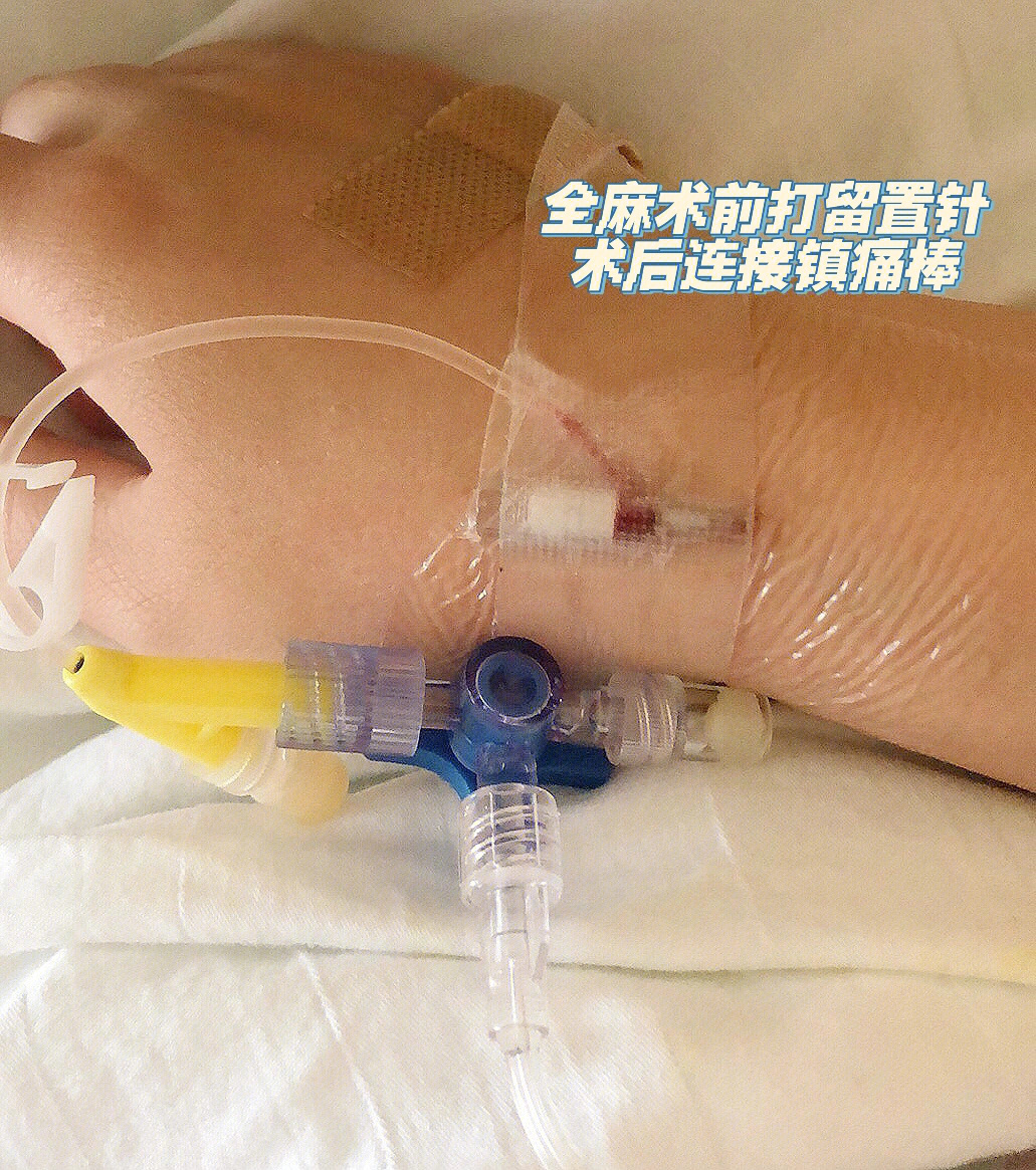 剖腹产麻醉棒图片图片