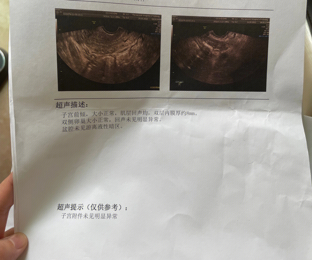 畸胎瘤脂液分层征图片