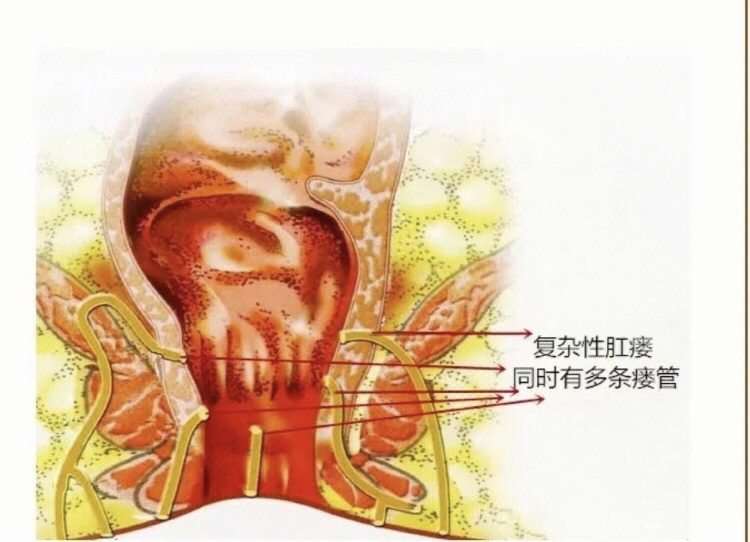 肛瘘前期症状图片初期图片