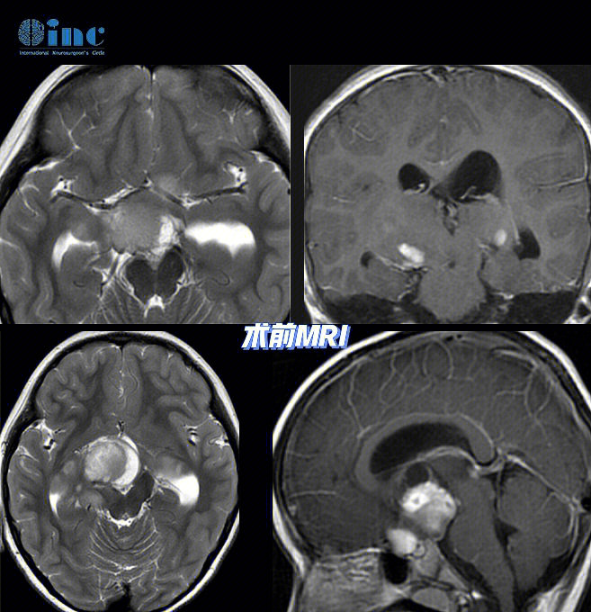 3岁男孩康康患视神经下丘脑胶质瘤,累及肿瘤累及视神经,视交叉,视束