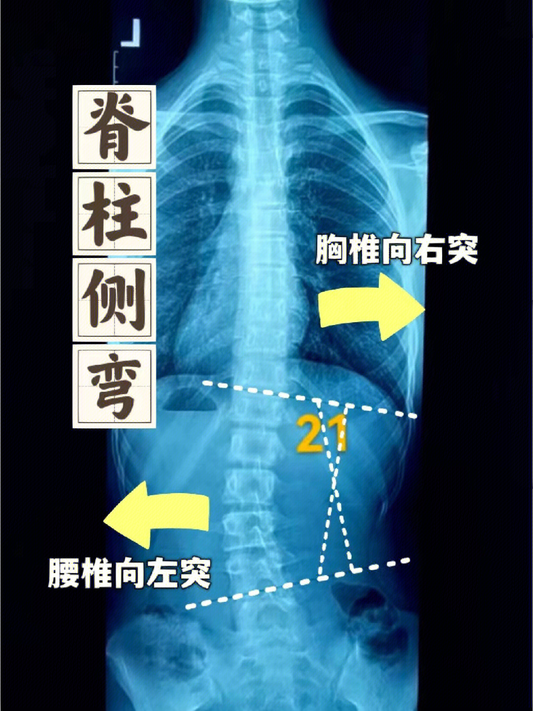 脊柱一侧肌肉凸起图片