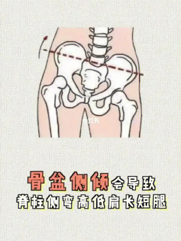 骨盆侧倾带来的腰痛和其他部位的问题