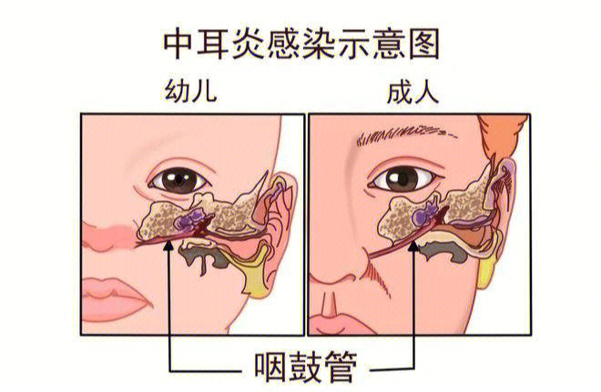 鼓室图宽度正常范围图片