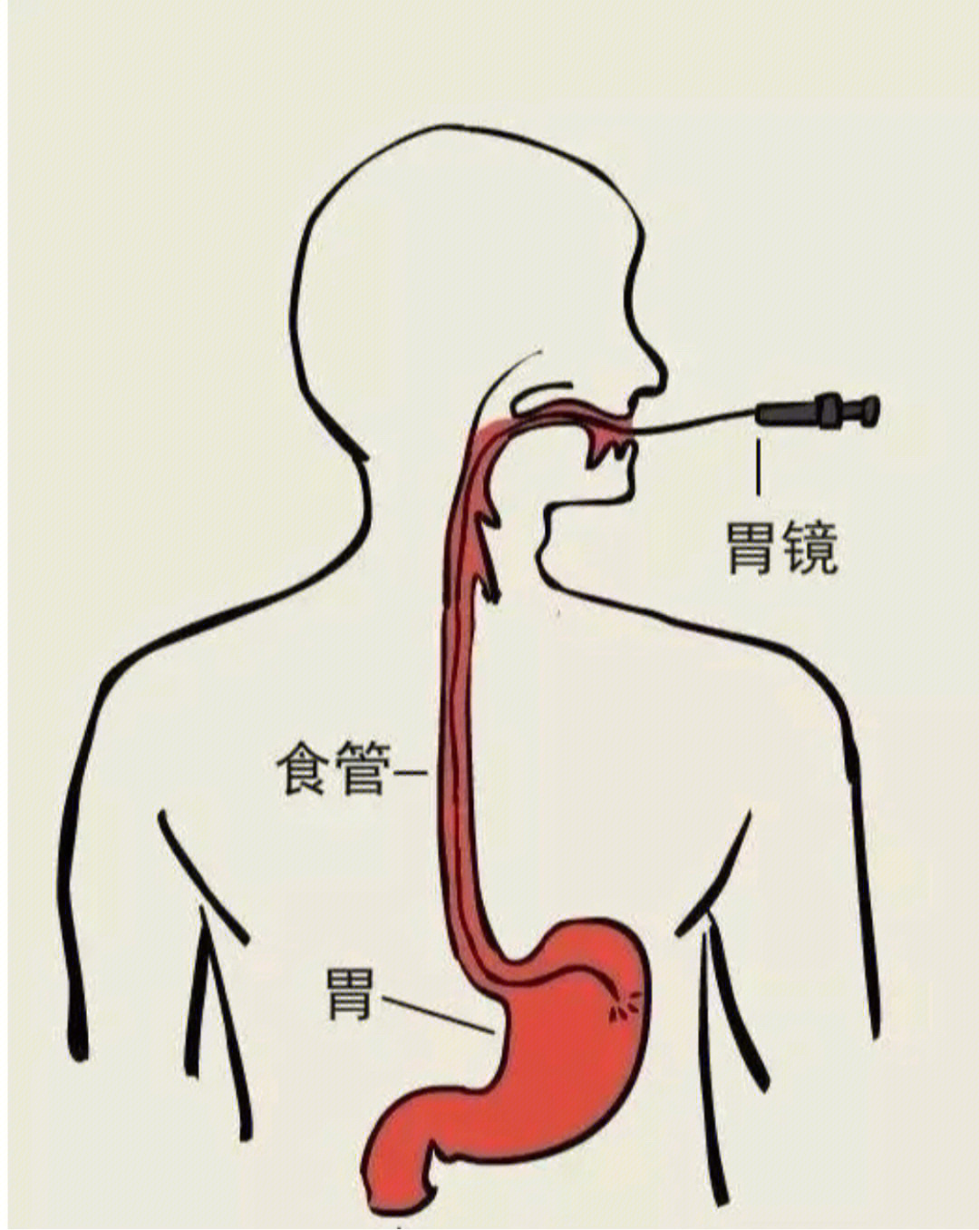 肠镜姿势示意图图片