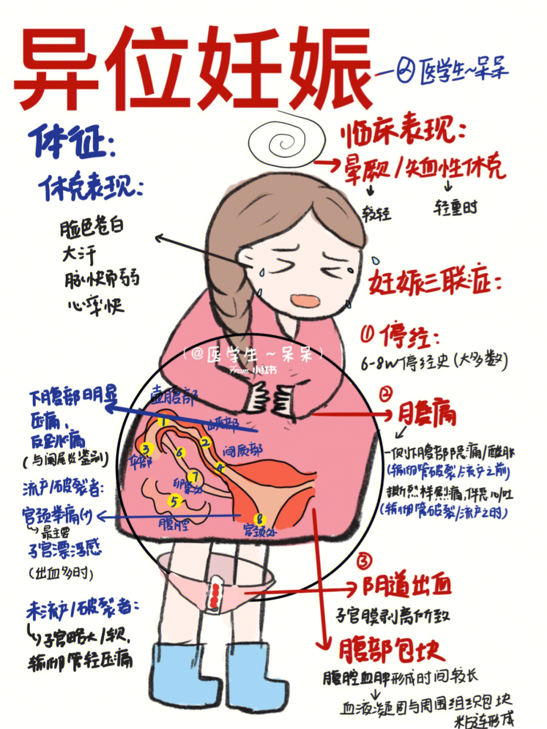 实习异位妊娠(宫外孕):96当月经规律育龄期女性出现月经停经,腹痛