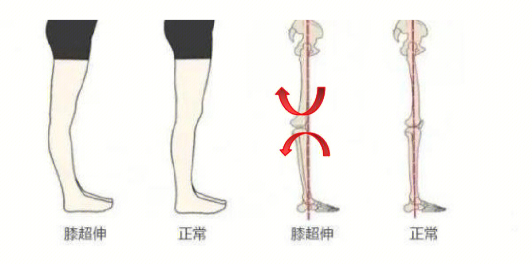 膝盖超伸怎么办图片