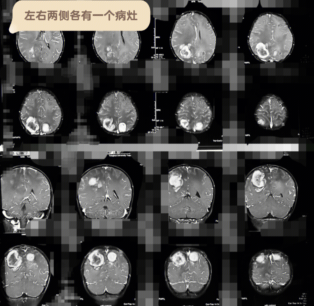 神经母细胞瘤早期症状图片