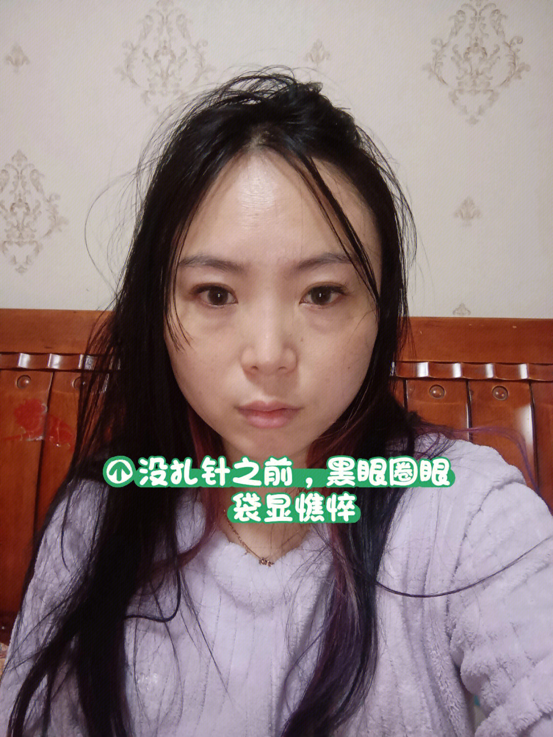 记录一下揿针美容开始扎第二次了