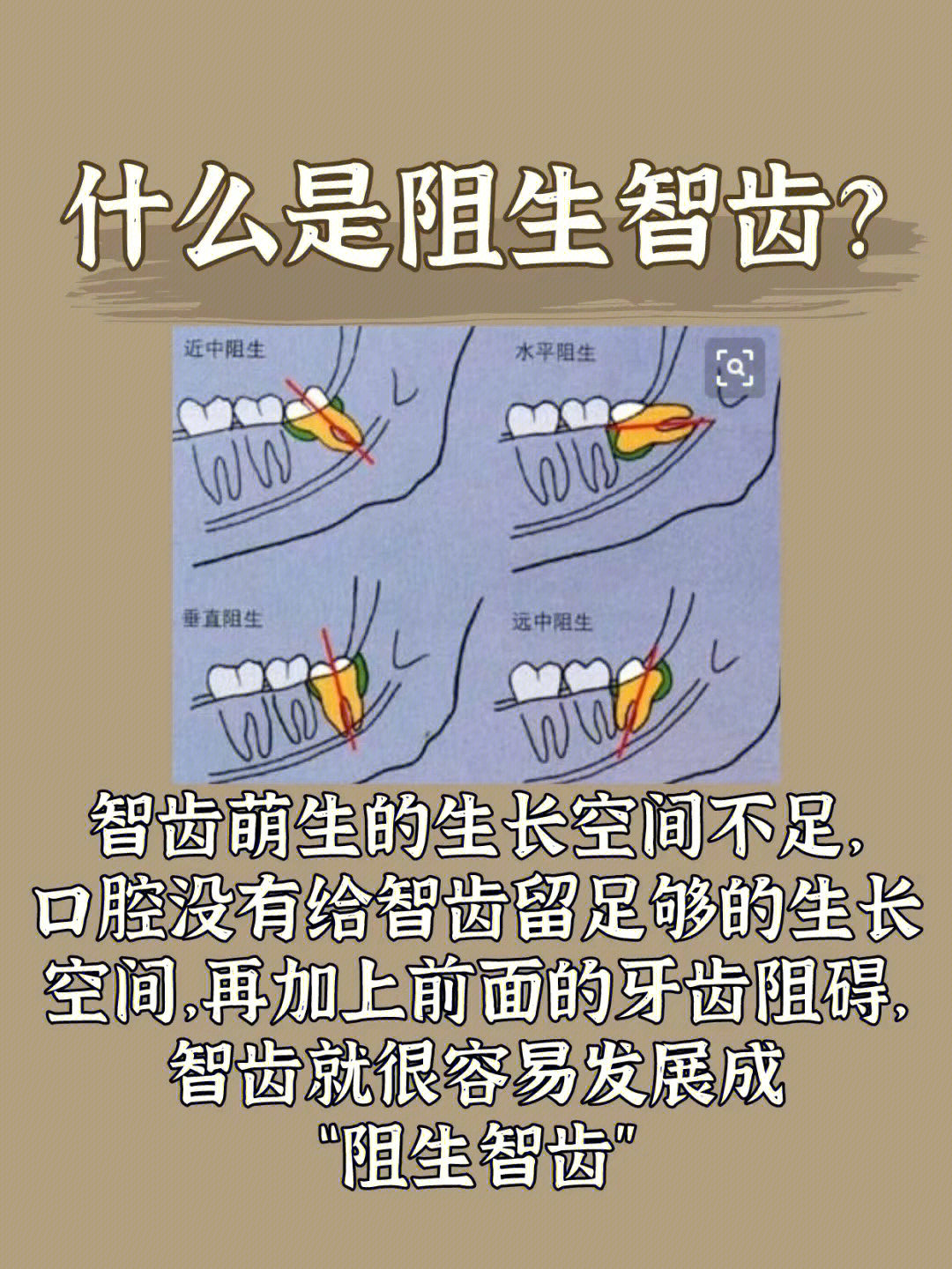 本人四颗不同类型的智齿(舌向阻生,脸颊阻生,垂直阻生)一上火就疼得