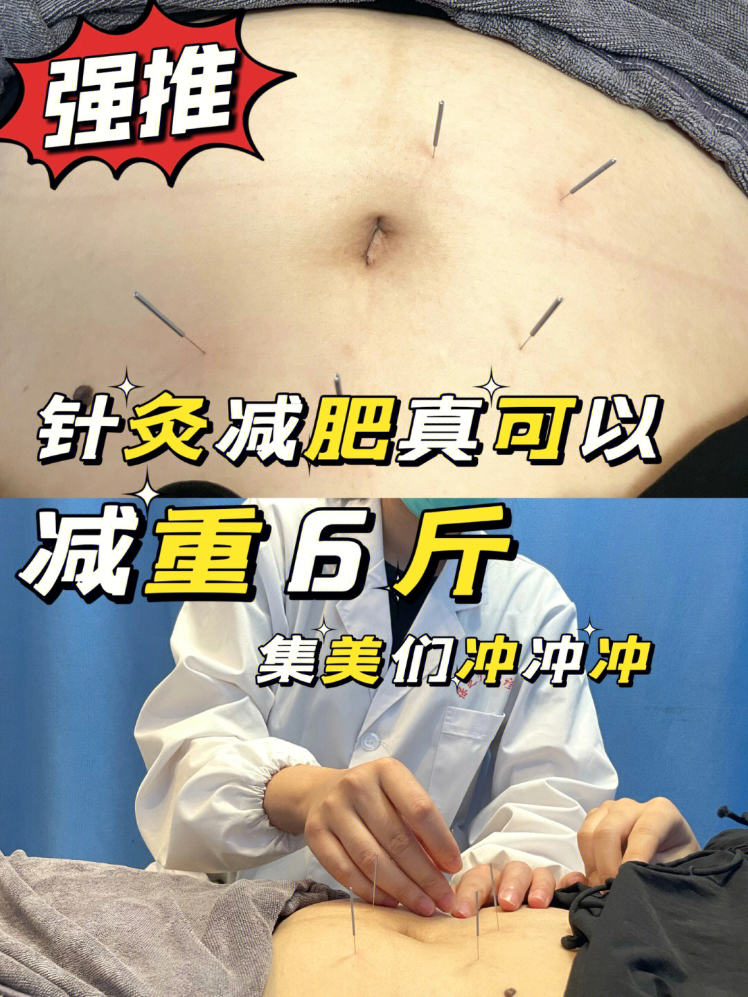 减肥针灸扎针部位图图片