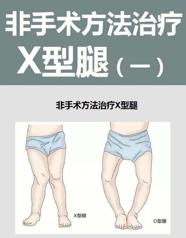 x型腿怎么矫正手术图片