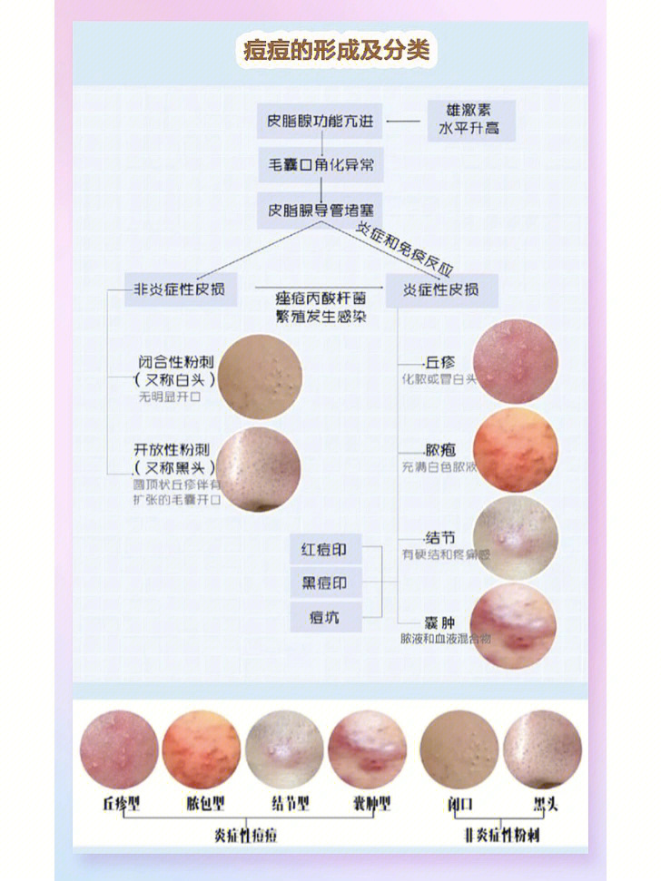 粉刺类型对应图片图片