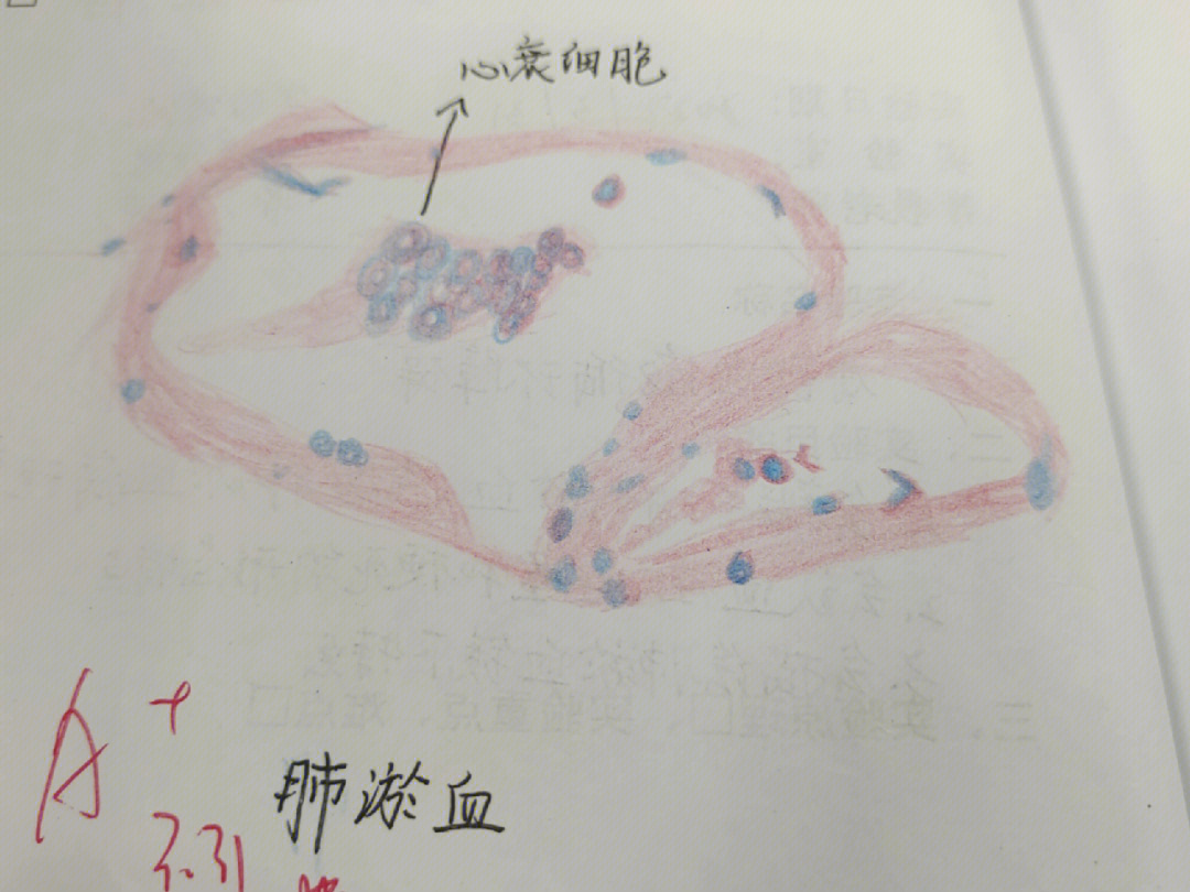 心肌梗死切片手绘图图片