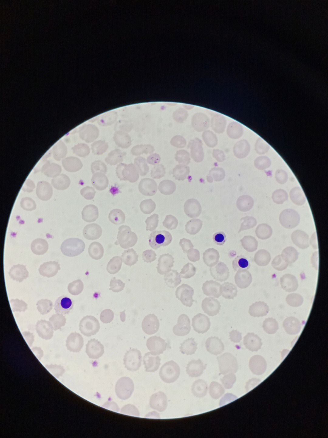 ida血涂片镜下晚幼红细胞