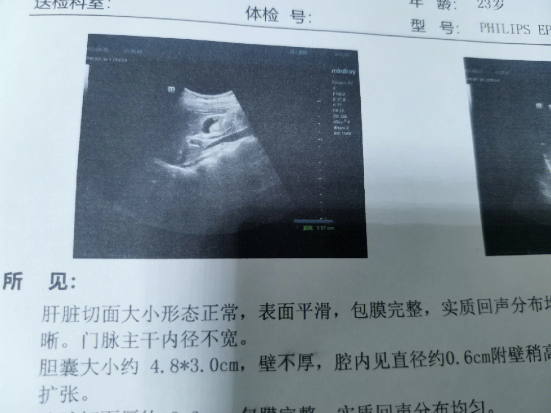 胆囊息肉3mm图片