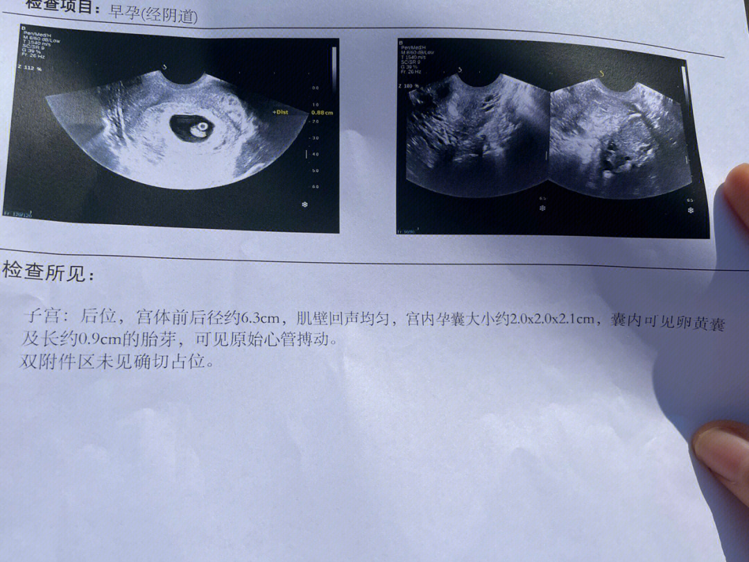 孕30周胎心位置图图片