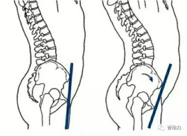 腰背痛假翘臀小腹突出可能是骨盆不正